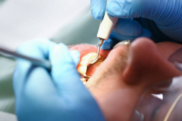 Best Broken or Cracked Tooth Emergency Dentist in White Haven, PA
