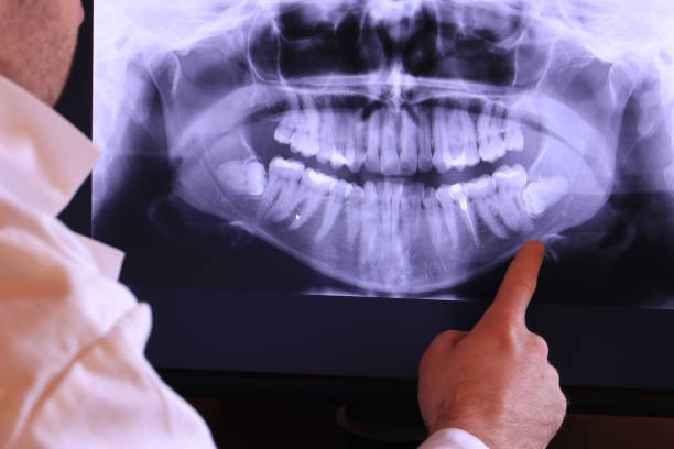 Best Emergency Dentist for Lost Fillings or Crowns in White Haven, PA